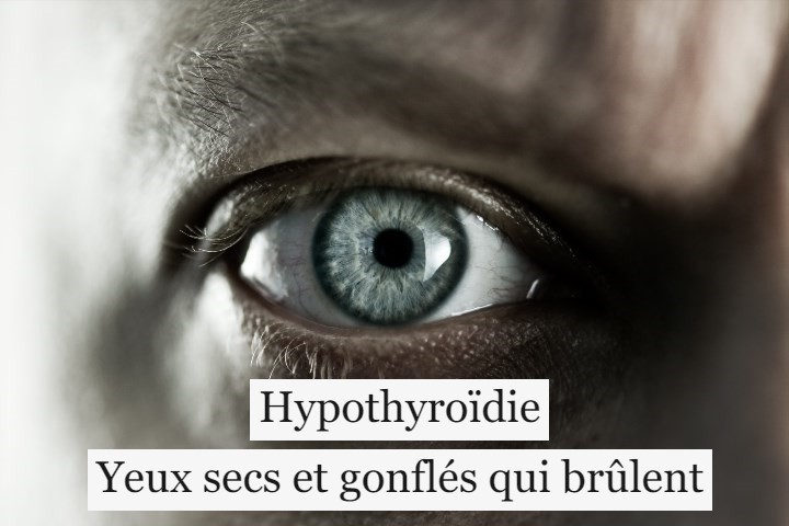 Hypothyroïdie : yeux secs et gonflés qui brûlent